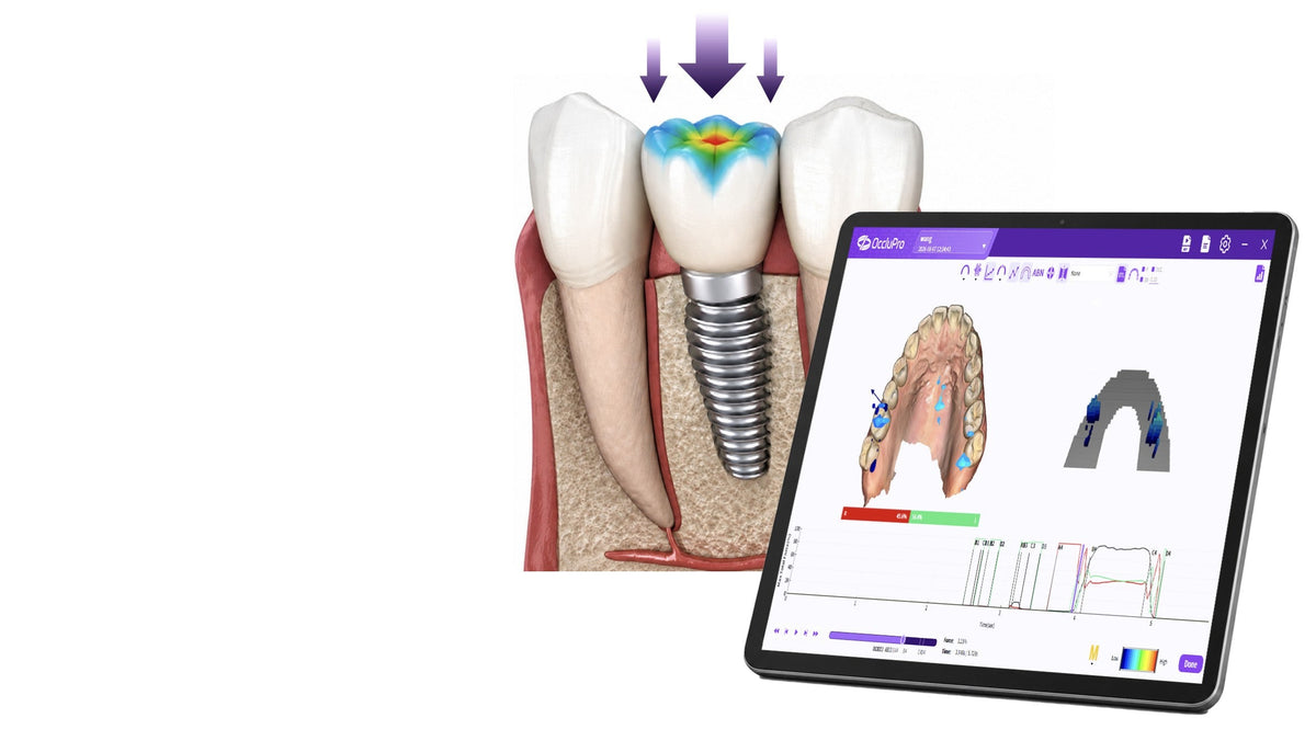 Digital Occlusal Analysis for Implant Dentistry